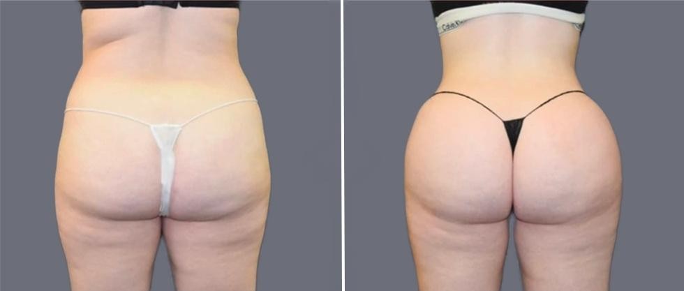 Brazilian Butt Lift Pre2024 008 Before And After