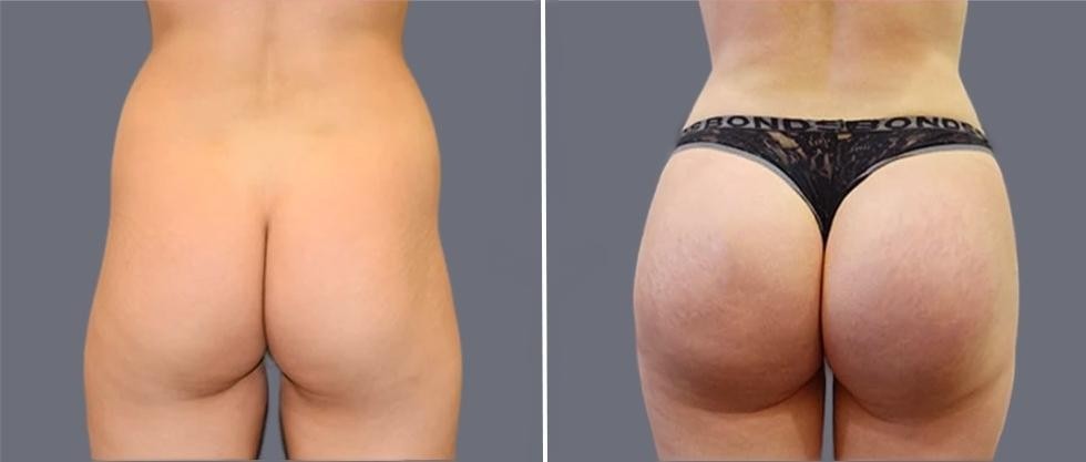 Brazilian Butt Lift Pre2024 009 Before And After