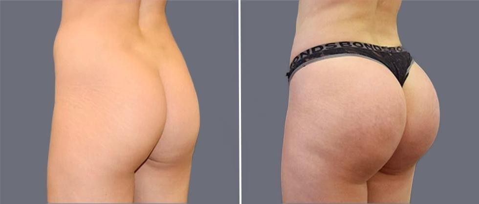 Brazilian Butt Lift Pre2024 010 Before And After