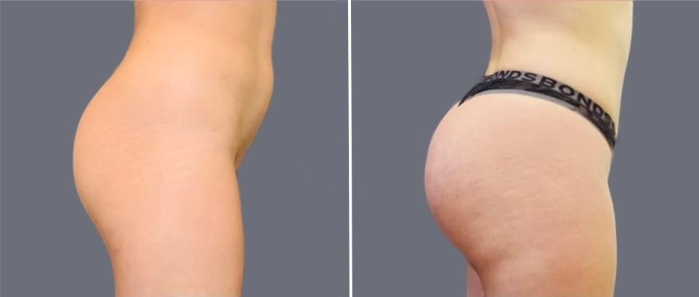 Brazilian Butt Lift Pre2024 011 Before And After