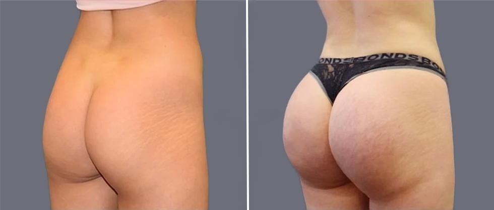 Brazilian Butt Lift Pre2024 012 Before And After