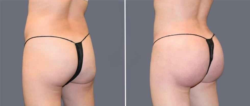 Brazilian Butt Lift Pre2024 013 Before And After