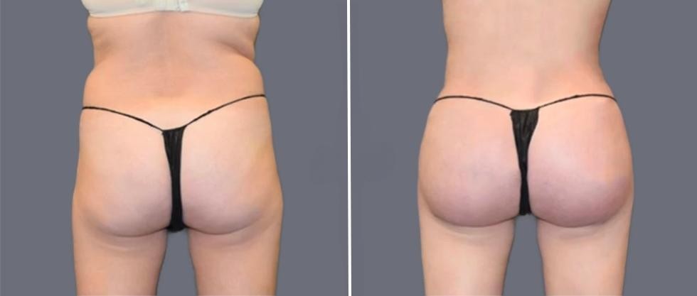 Brazilian Butt Lift Pre2024 014 Before And After
