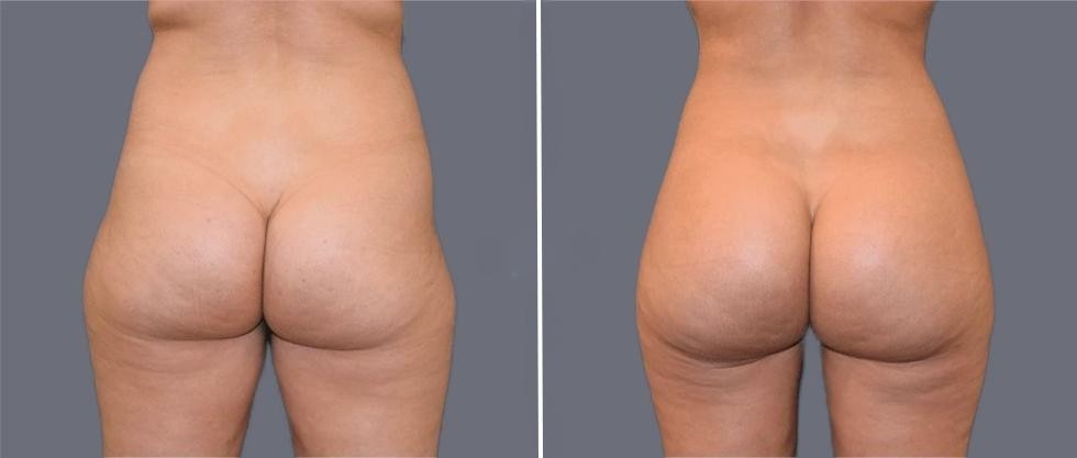 Brazilian Butt Lift Pre2024 015 Before And After