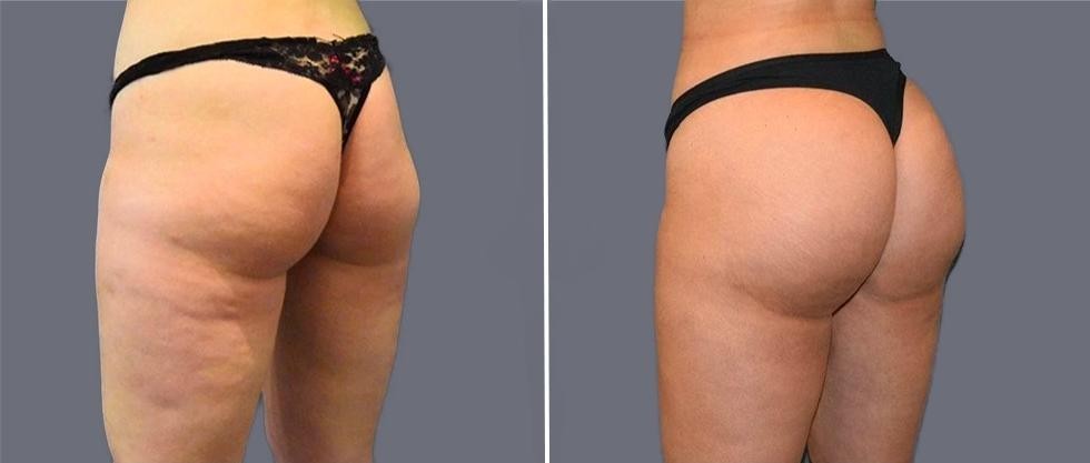 Brazilian Butt Lift Pre2024 016 Before And After