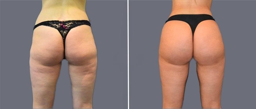 Brazilian Butt Lift Pre2024 017 Before And After