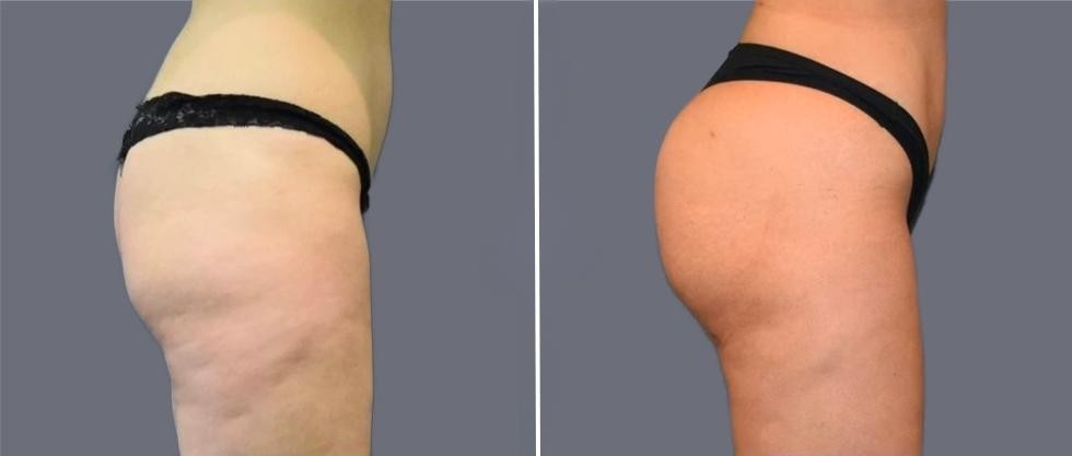 Brazilian Butt Lift Pre2024 018 Before And After
