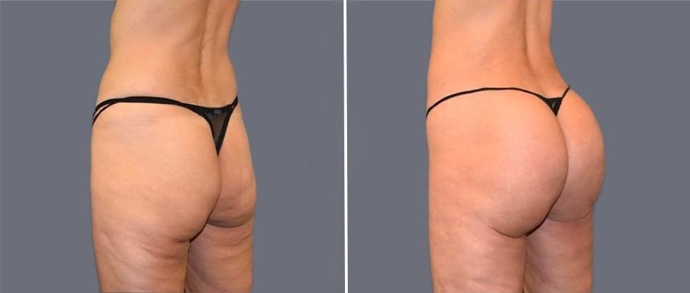Brazilian Butt Lift Pre2024 019 Before And After