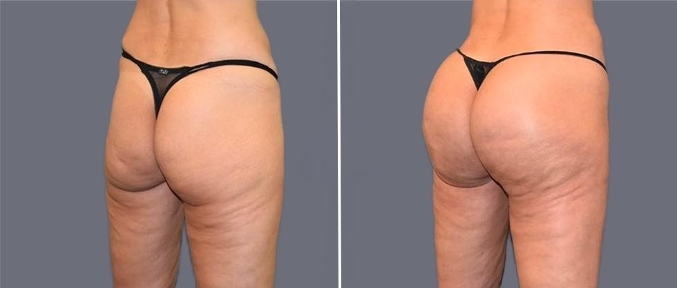 Brazilian Butt Lift Pre2024 020 Before And After