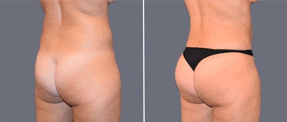Brazilian Butt Lift Pre2024 021 Before And After