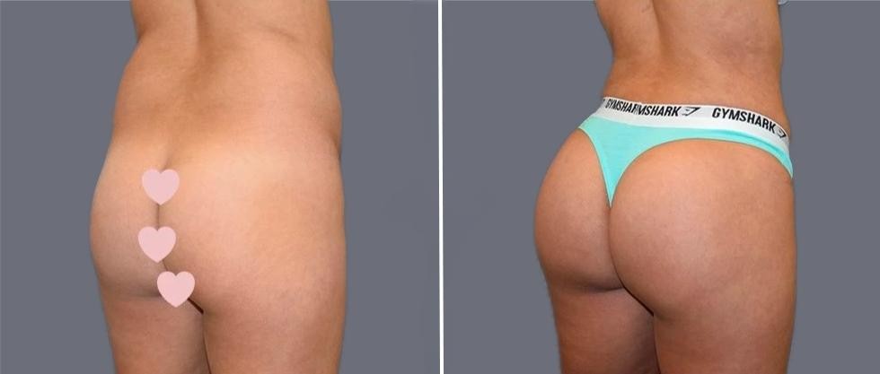 Brazilian Butt Lift Pre2024 022 Before And After