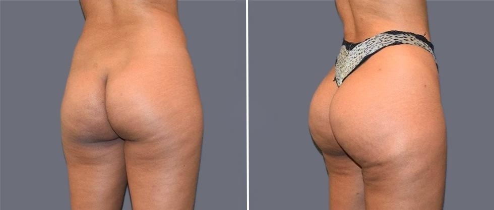 Brazilian Butt Lift Pre2024 023 Before And After