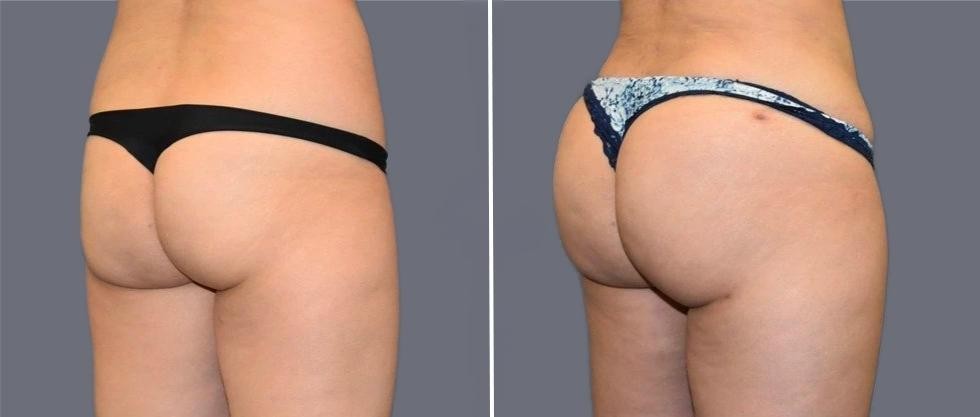 Brazilian Butt Lift Pre2024 024 Before And After