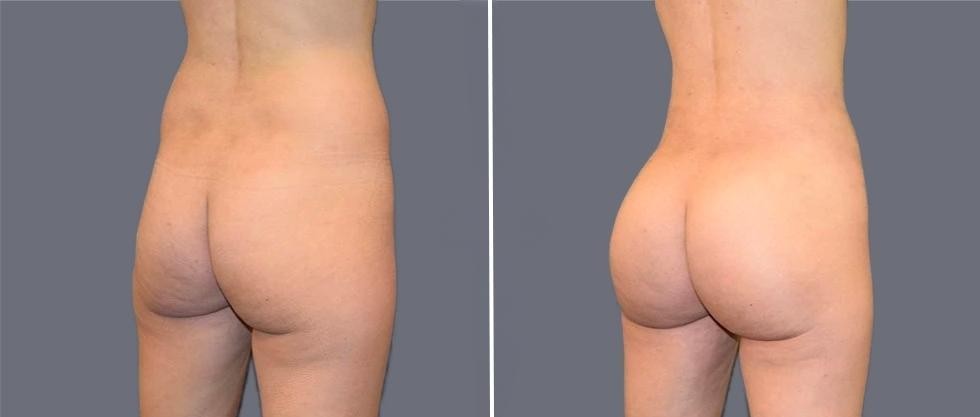 Brazilian Butt Lift Pre2024 025 Before And After