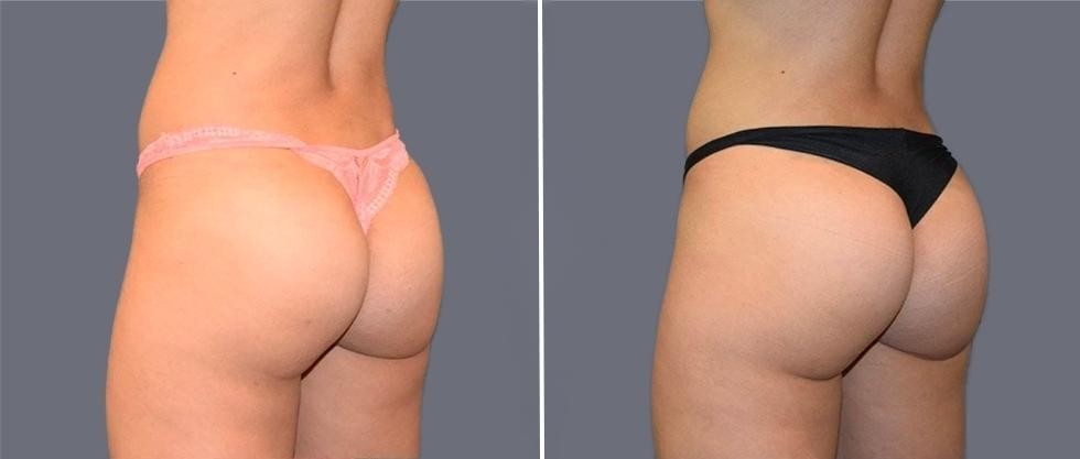 Brazilian Butt Lift Pre2024 026 Before And After