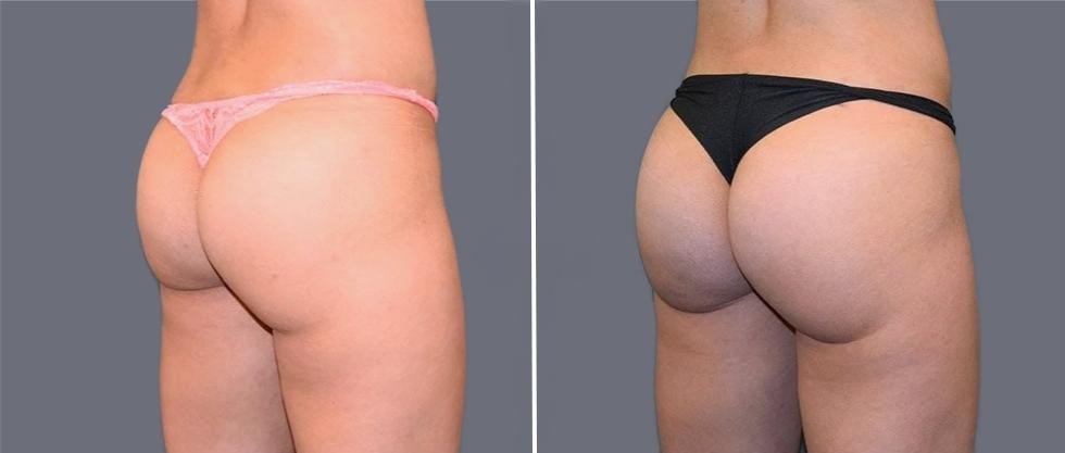 Brazilian Butt Lift Pre2024 027 Before And After