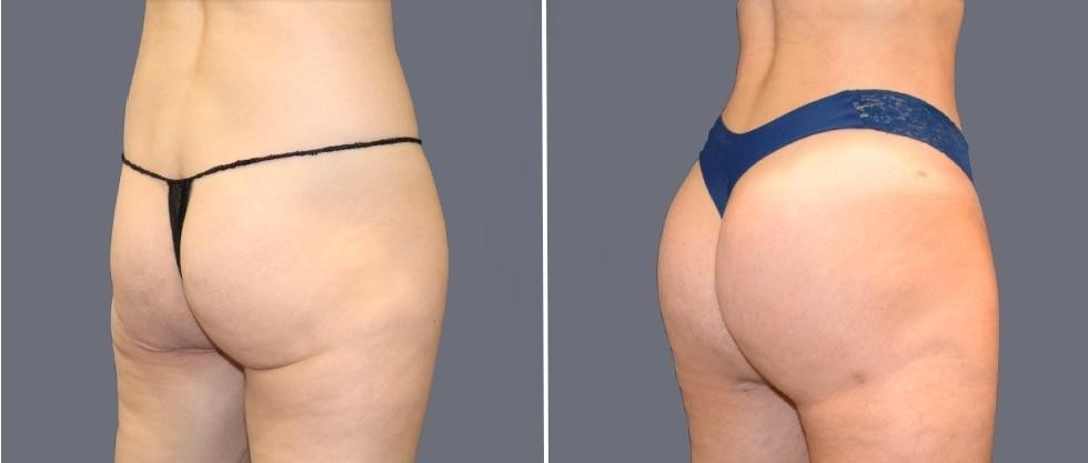 Brazilian Butt Lift Pre2024 064 Before And After
