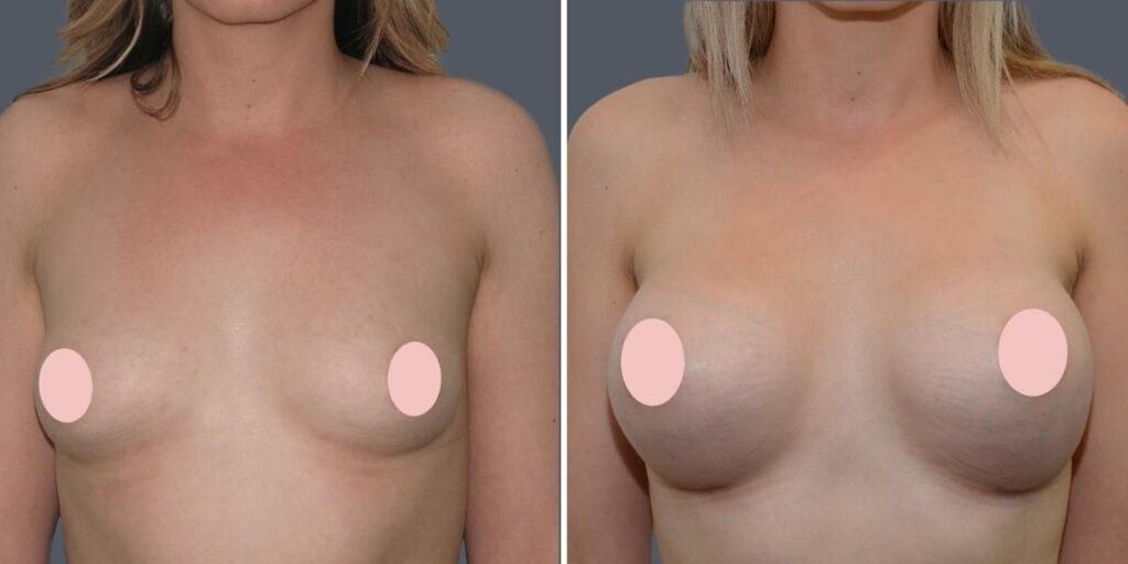Breast Augmentation Female Pre2024 001 Before And After
