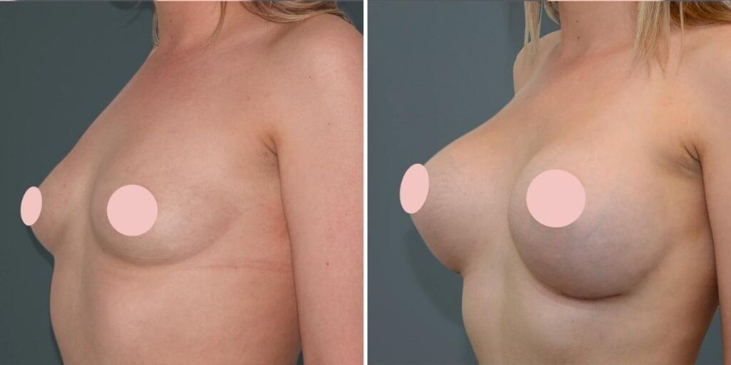 Breast Augmentation Female Pre2024 002 Before And After