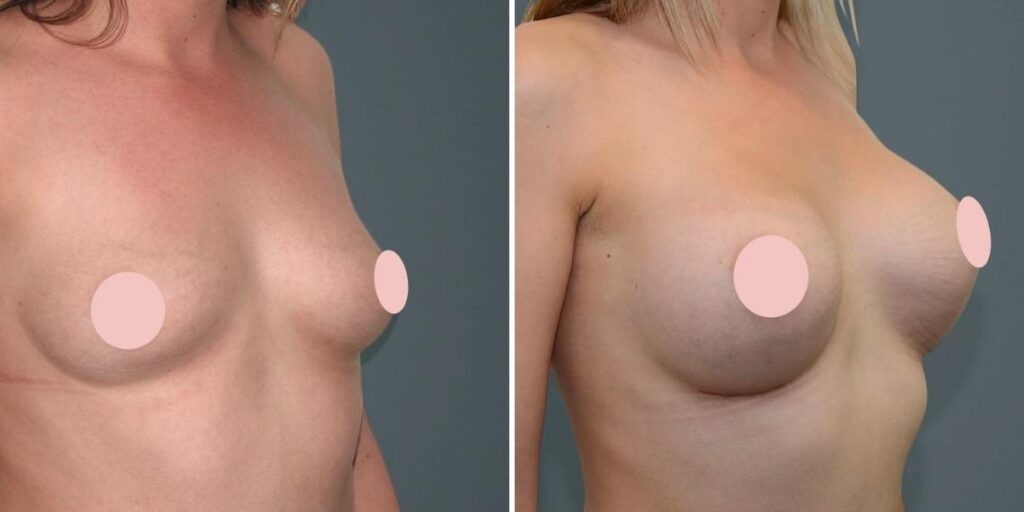 Breast Augmentation Female Pre2024 003 Before And After