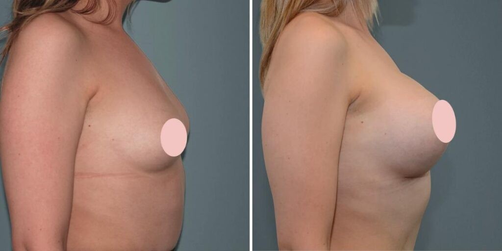 Breast Augmentation Female Pre2024 004 Before And After