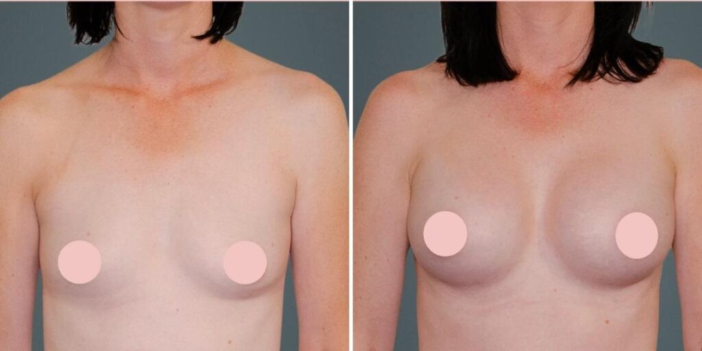 Breast Augmentation Female Pre2024 005 Before And After