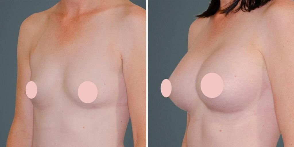 Breast Augmentation Female Pre2024 006 Before And After