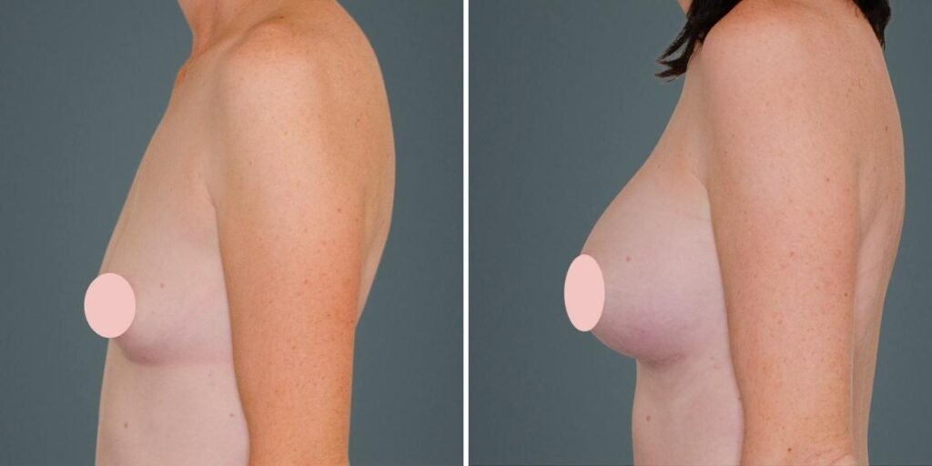 Breast Augmentation Female Pre2024 007 Before And After