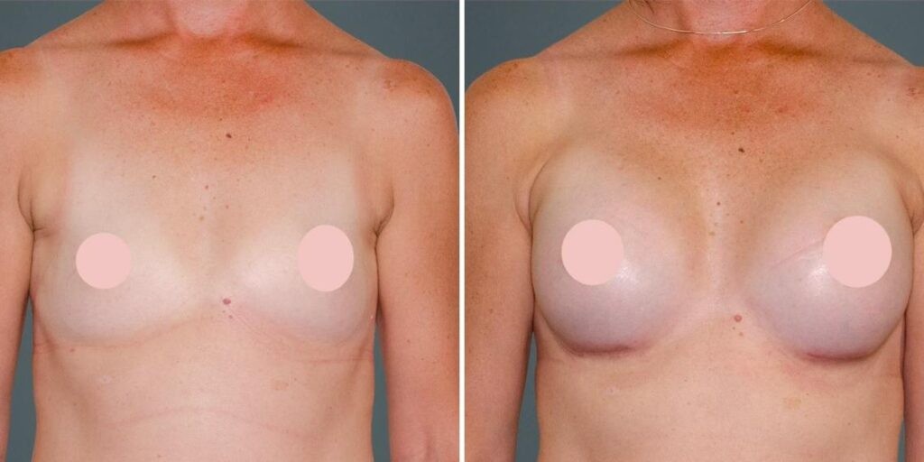 Breast Augmentation Female Pre2024 008 Before And After