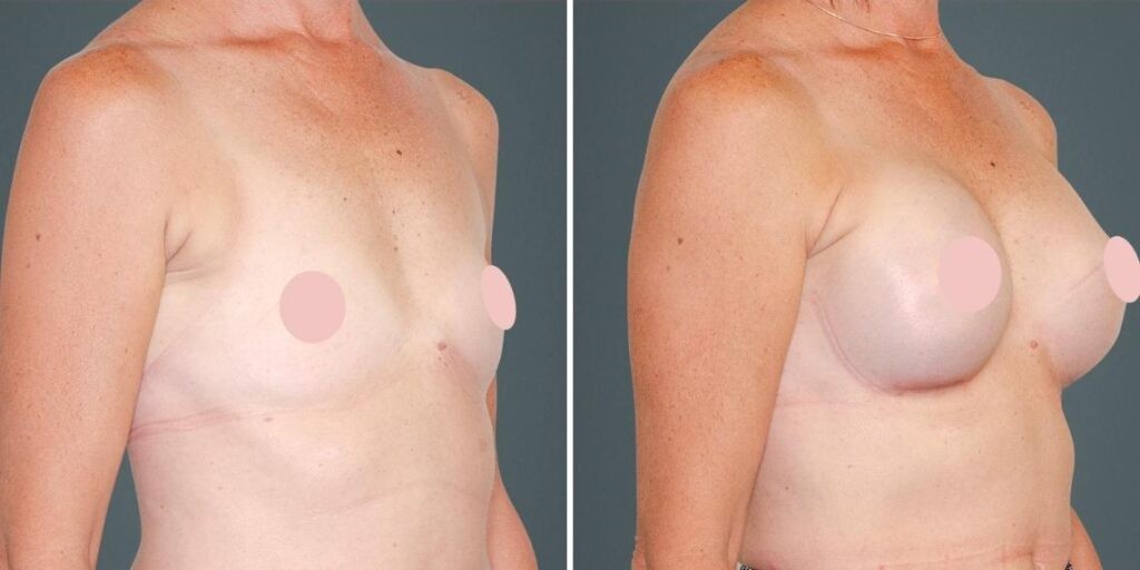 Breast Augmentation Female Pre2024 009 Before And After