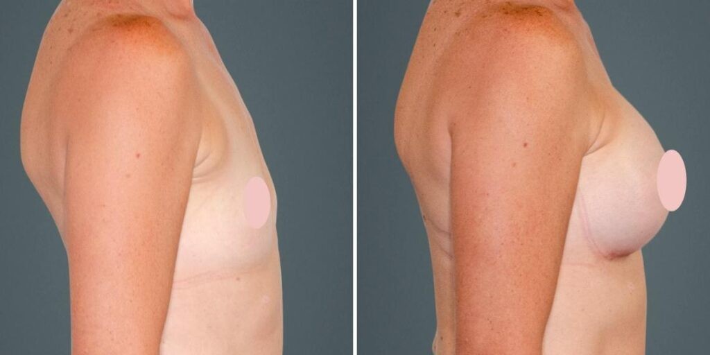 Breast Augmentation Female Pre2024 010 Before And After