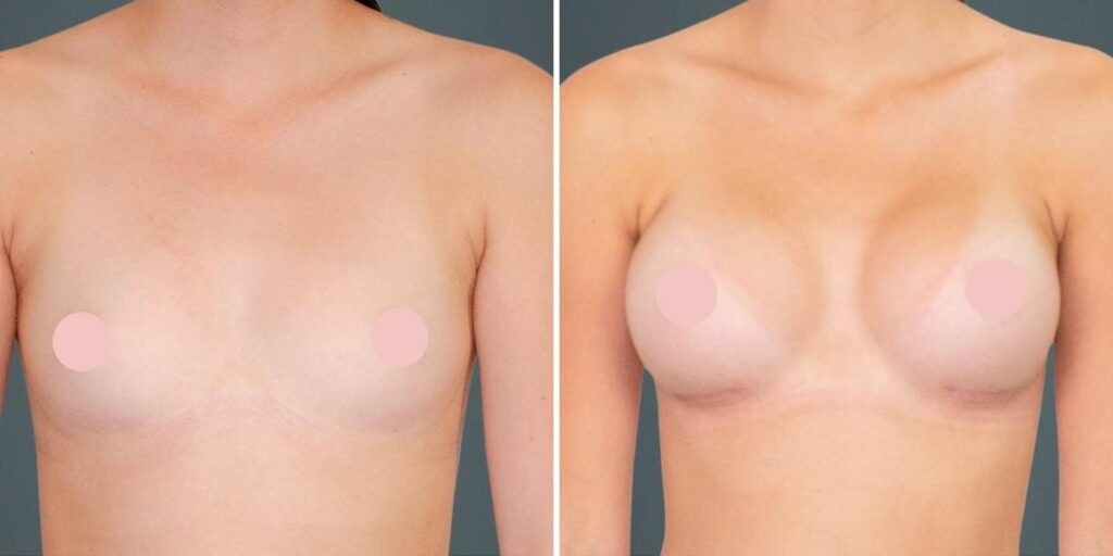 Breast Augmentation Female Pre2024 011 Before And After