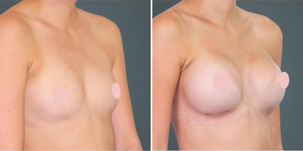 Breast Augmentation Female Pre2024 012 Before And After