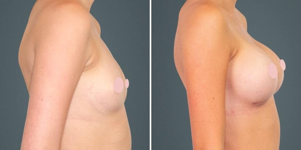 Breast Augmentation Female Pre2024 013 Before And After