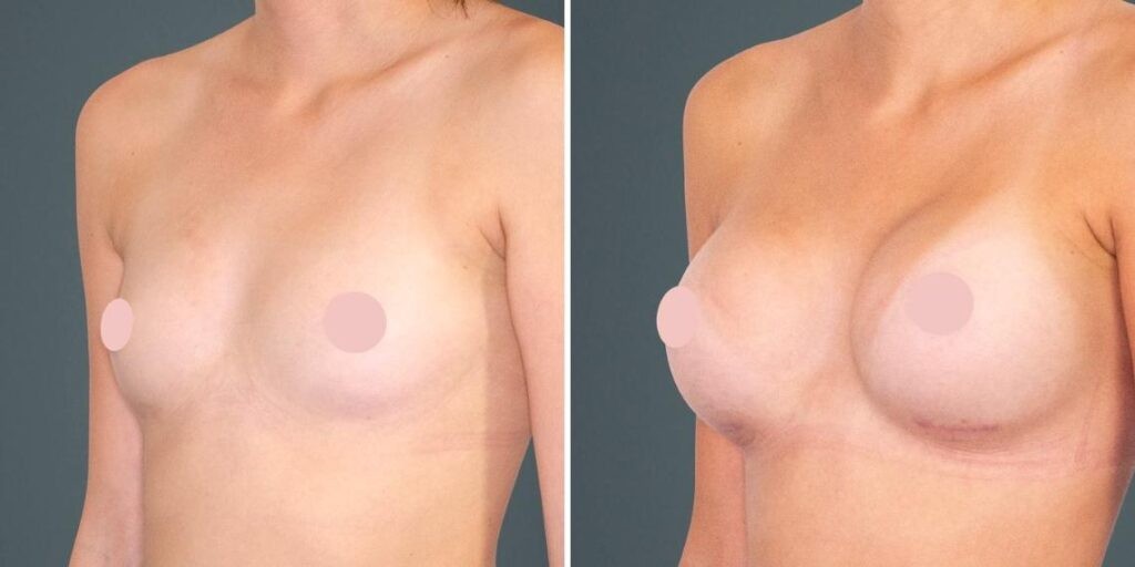 Breast Augmentation Female Pre2024 014 Before And After