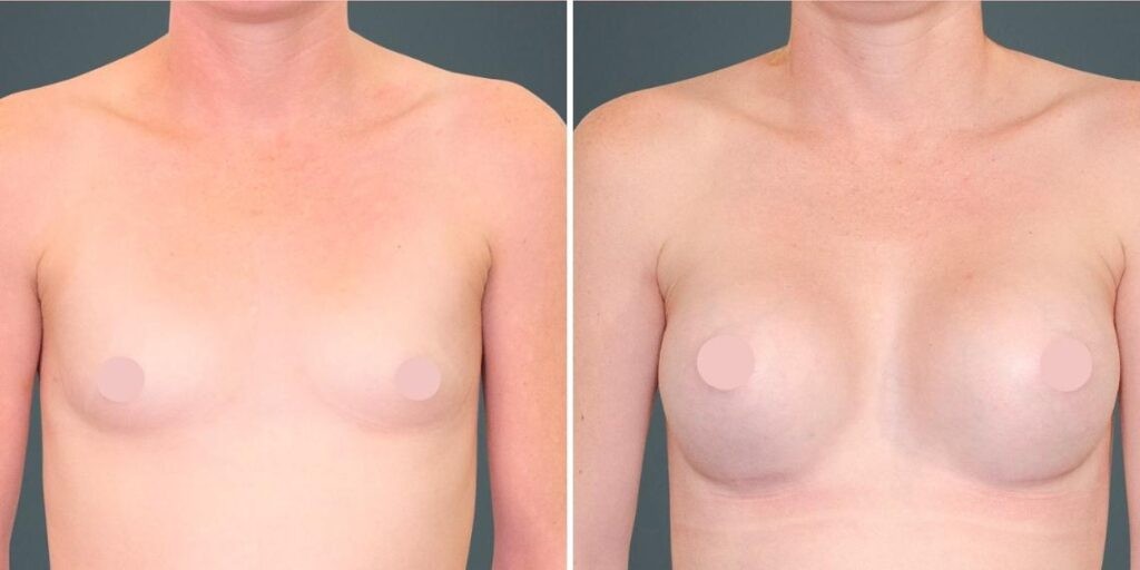 Breast Augmentation Female Pre2024 015 Before And After