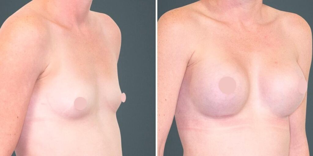 Breast Augmentation Female Pre2024 016 Before And After