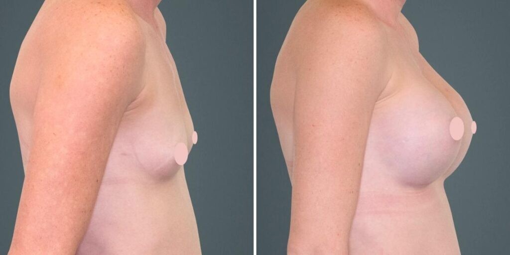 Breast Augmentation Female Pre2024 017 Before And After