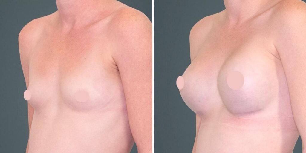 Breast Augmentation Female Pre2024 018 Before And After