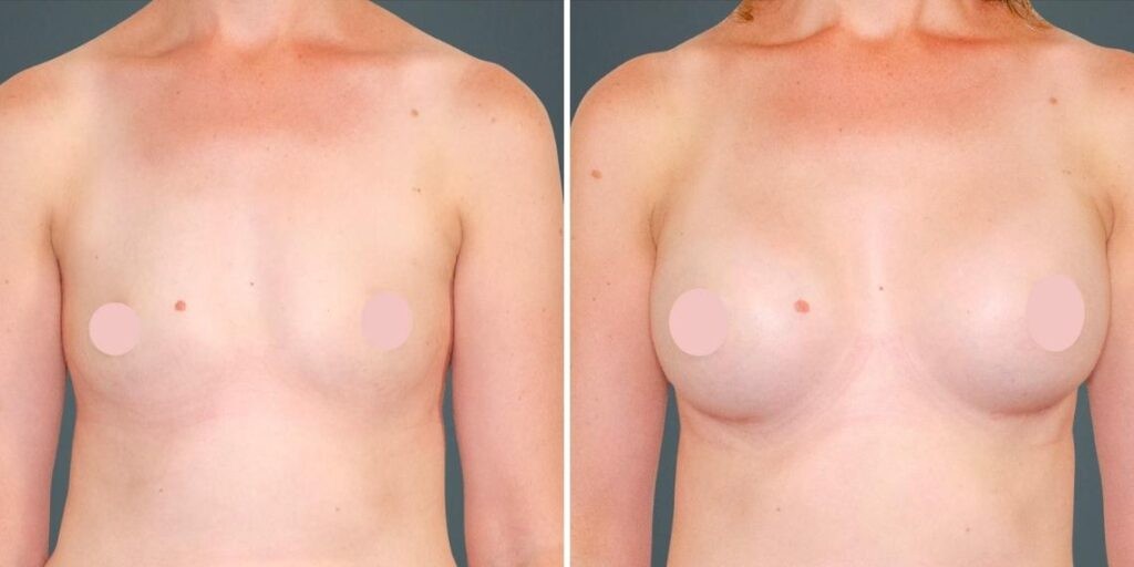 Breast Augmentation Female Pre2024 019 Before And After