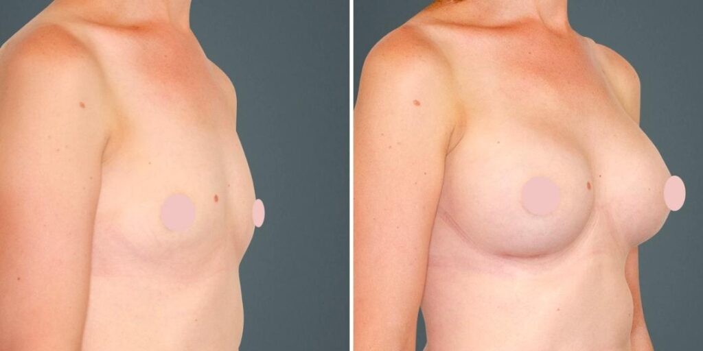 Breast Augmentation Female Pre2024 020 Before And After