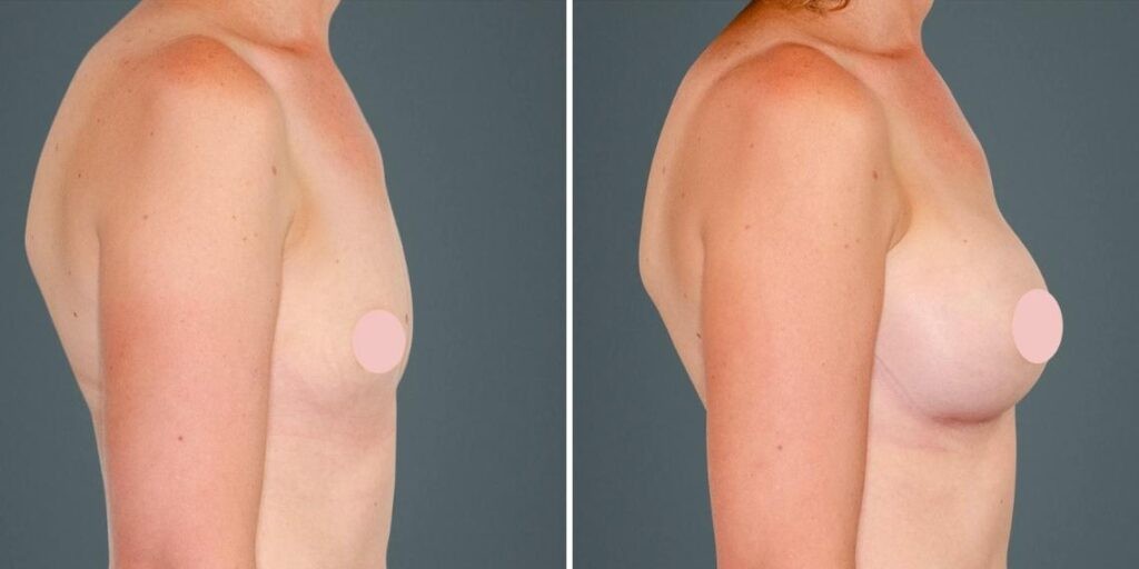 Breast Augmentation Female Pre2024 021 Before And After