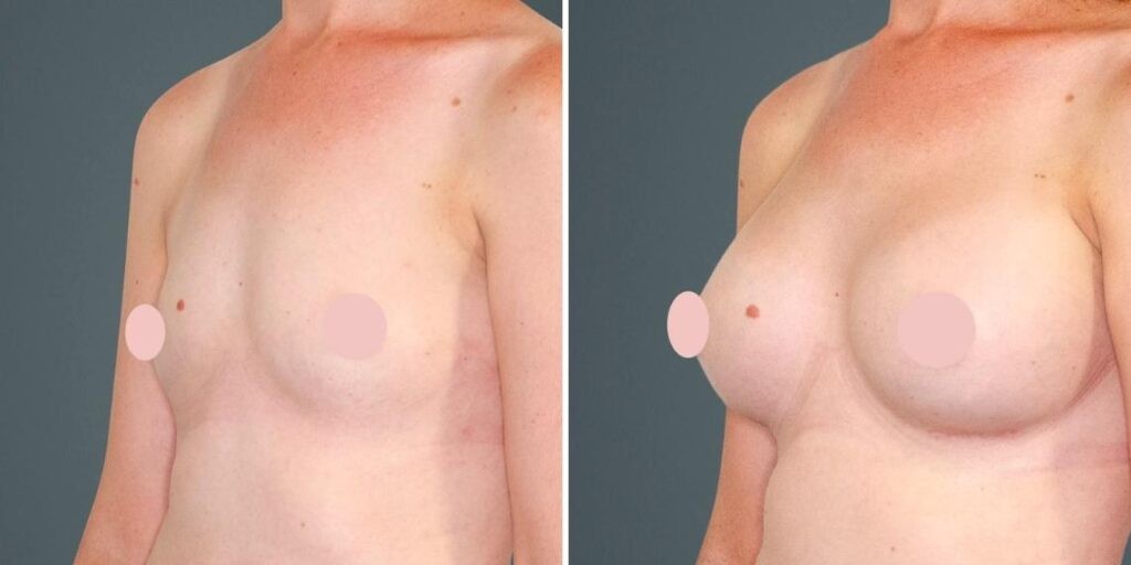 Breast Augmentation Female Pre2024 022 Before And After