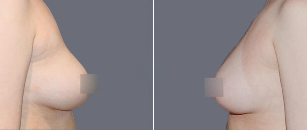 Breast Fat Transfer Pre2024 001 Before And After