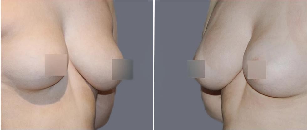 Breast Fat Transfer Pre2024 002 Before And After