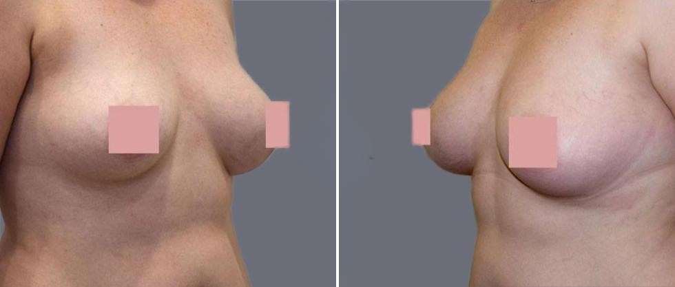 Breast Fat Transfer Pre2024 003 Before And After