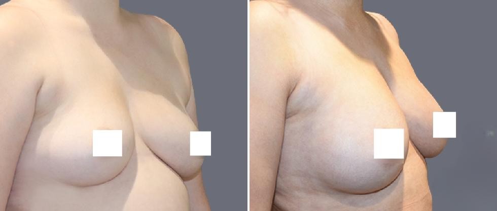 Breast Fat Transfer Pre2024 004 Before And After