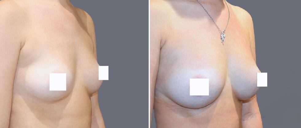 Breast Fat Transfer Pre2024 005 Before And After