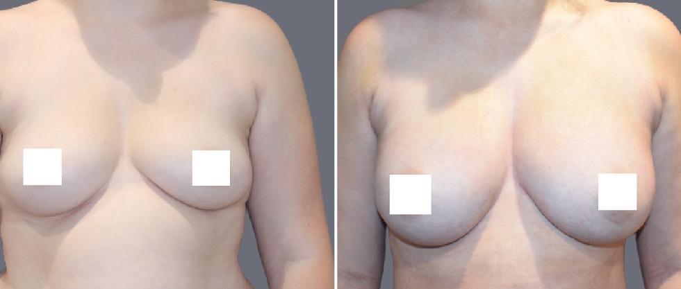 Breast Fat Transfer Pre2024 006 Before And After