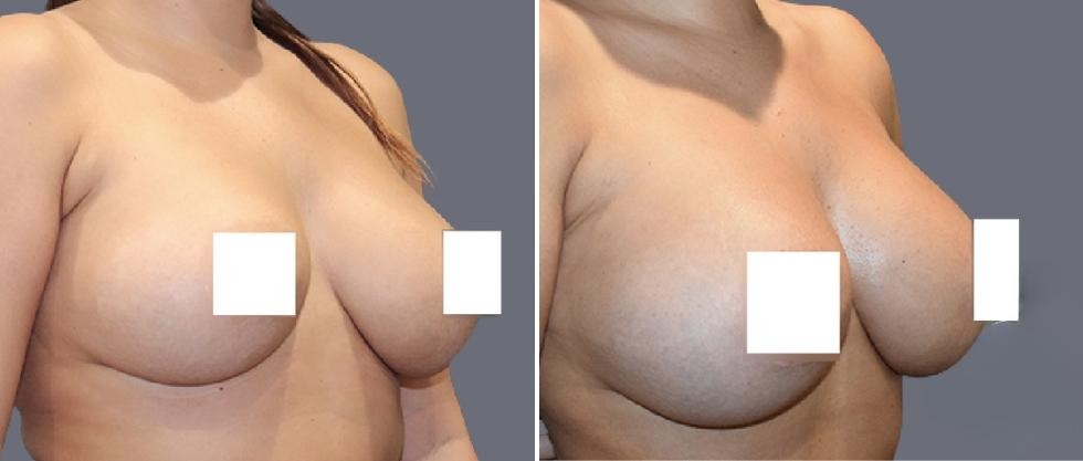 Breast Fat Transfer Pre2024 007 Before And After
